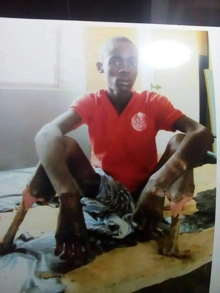 Cameroun: Ibrahim Bello, torturé et amputé par des policiers camerounais